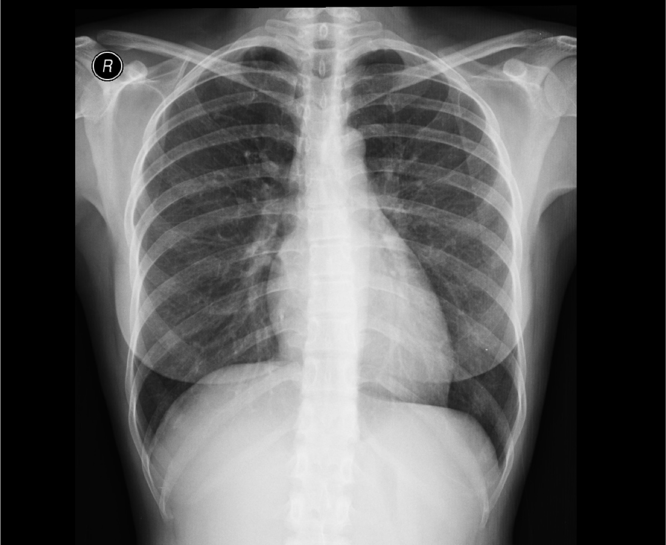 Radiografia simples de tórax normal