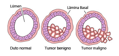 Esquemas mostrando o epitélio de um órgão tubular com a formação de um tumor benigno (circunscrito) e maligno (invasivo)